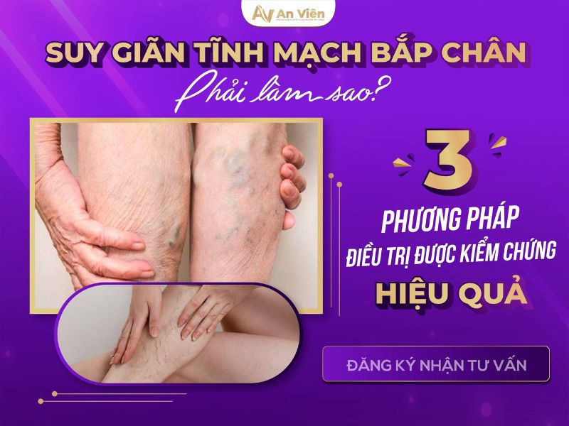 chữa suy giãn tĩnh mạch chân