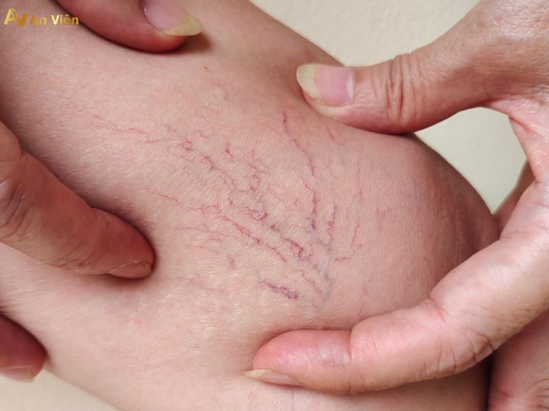 dấu hiệu của suy giãn tĩnh mạch chân