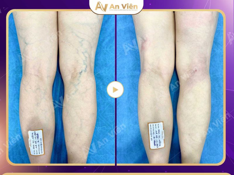dấu hiệu của suy giãn tĩnh mạch chân