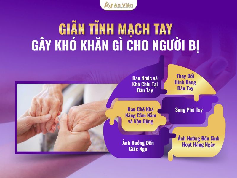 giãn tĩnh mạch tay