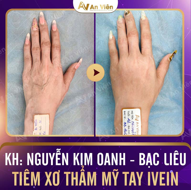 giãn tĩnh mạch tay 2