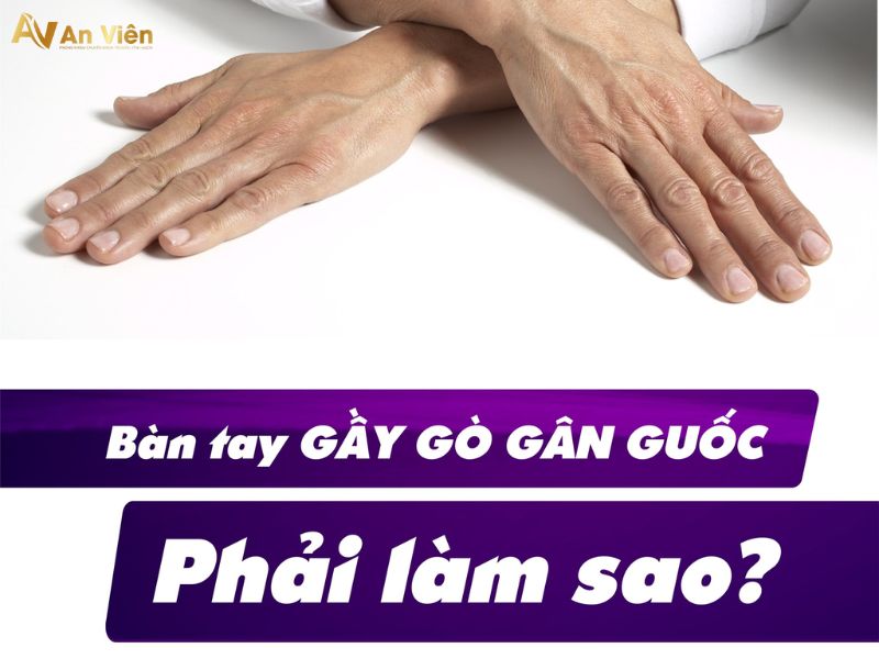 giãn tĩnh mạch tay 