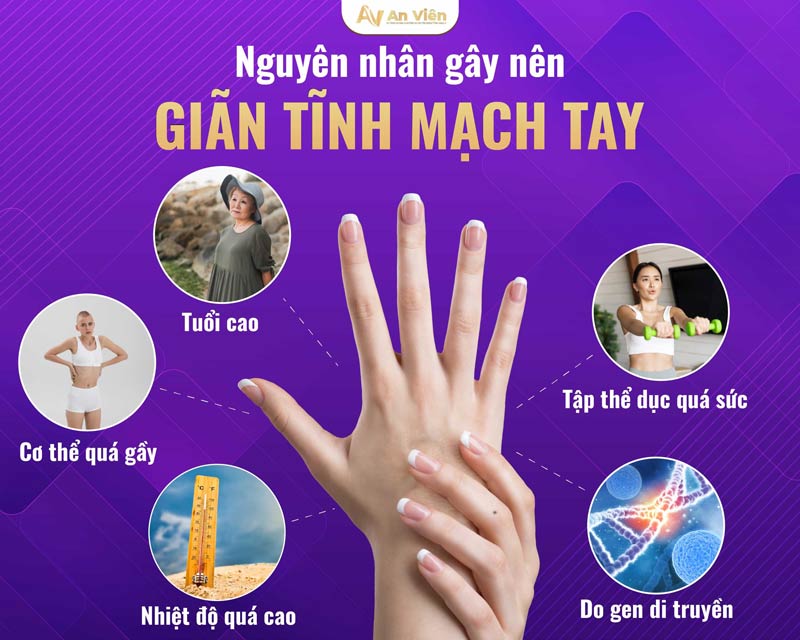 giãn tĩnh mạch tay