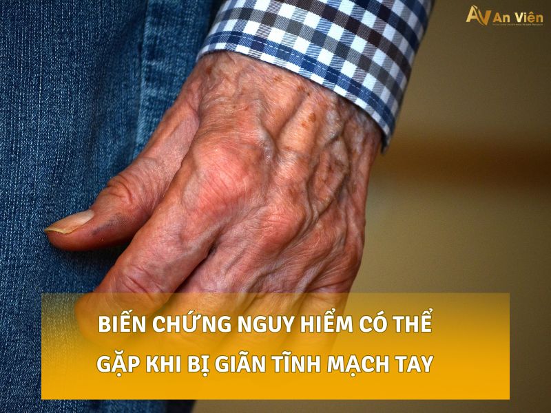 giãn tĩnh mạch tay