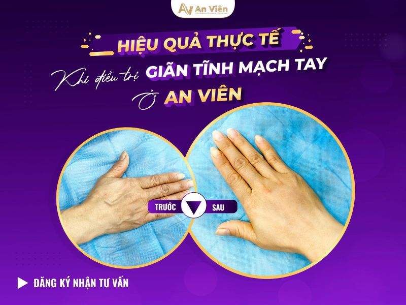 giãn tĩnh mạch tay