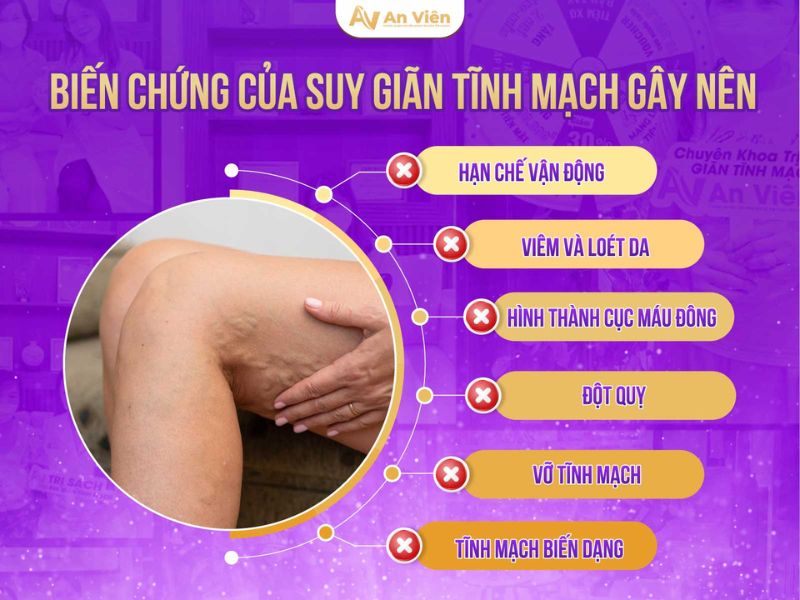 hình ảnh viêm tĩnh mạch