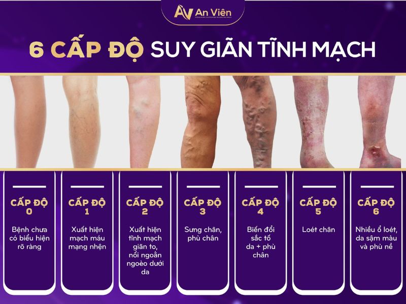hình ảnh viêm tĩnh mạch