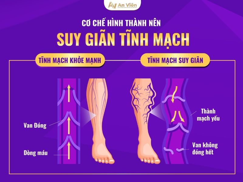 nguyên nhân giãn tĩnh mạch
