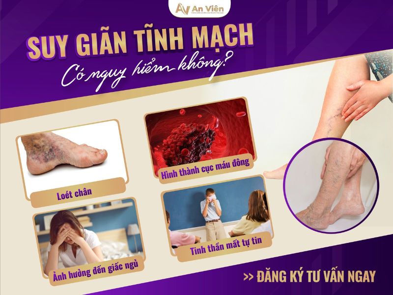 nổi gân máu ở chân