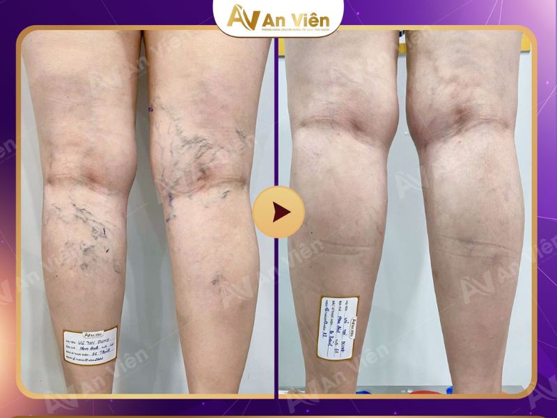 nổi gân máu ở chân
