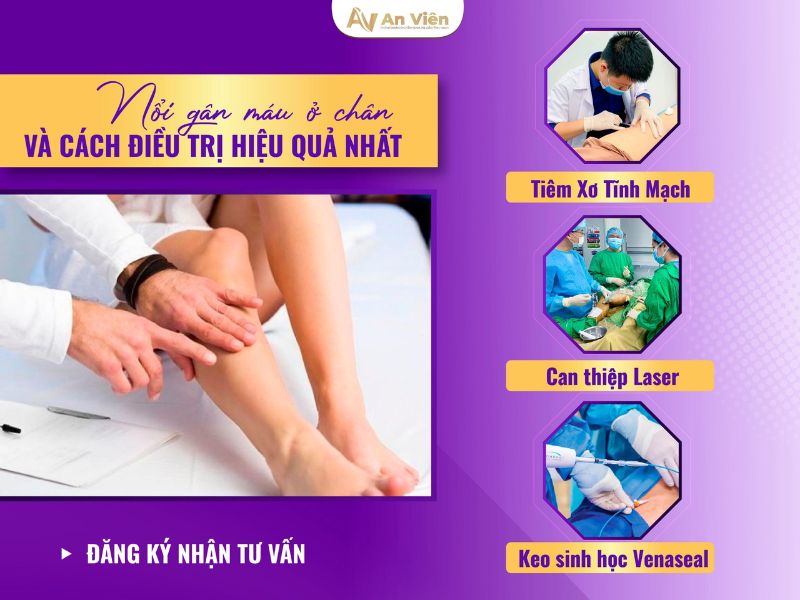 nổi gân máu ở chân