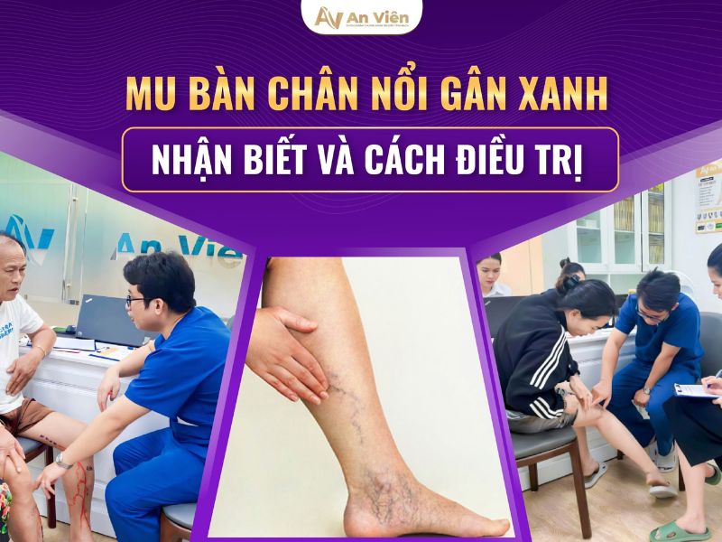 nổi mạch máu đỏ ở chân
