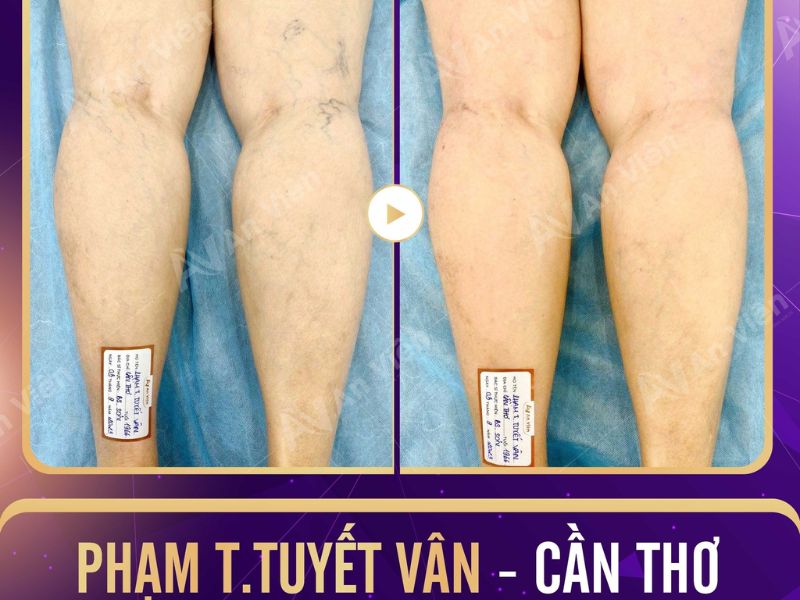 nổi mạch máu đỏ ở chân