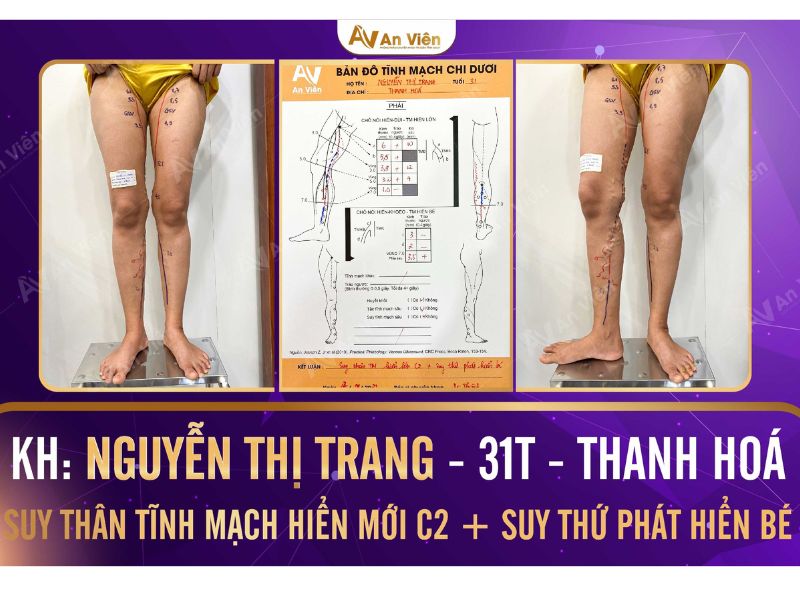 bệnh suy tĩnh mạch mạn ngoại biên