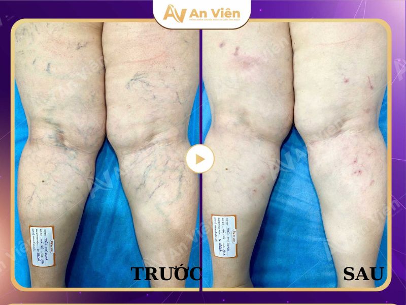 chạy laser nội mạch