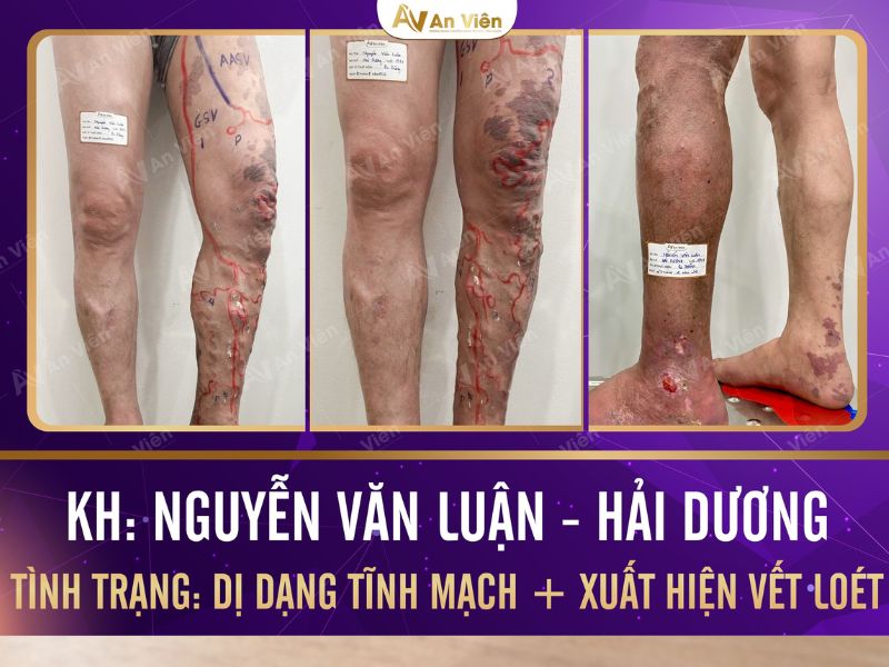dấu hiệu bị giãn tĩnh mạch chân