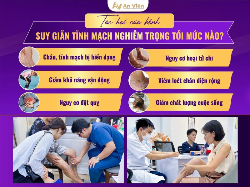 dấu hiệu bị giãn tĩnh mạch chân