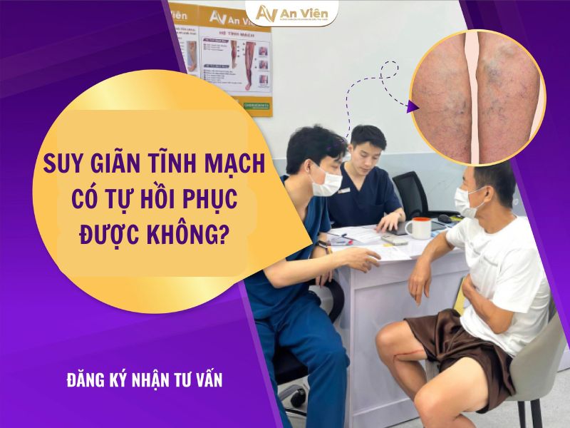 điều trị giãn tĩnh mạch chi dưới