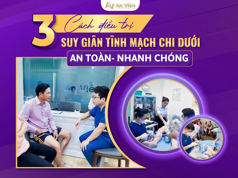 điều trị giãn tĩnh mạch chi dưới