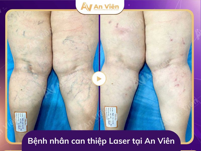 điều trị giãn tĩnh mạch chi dưới