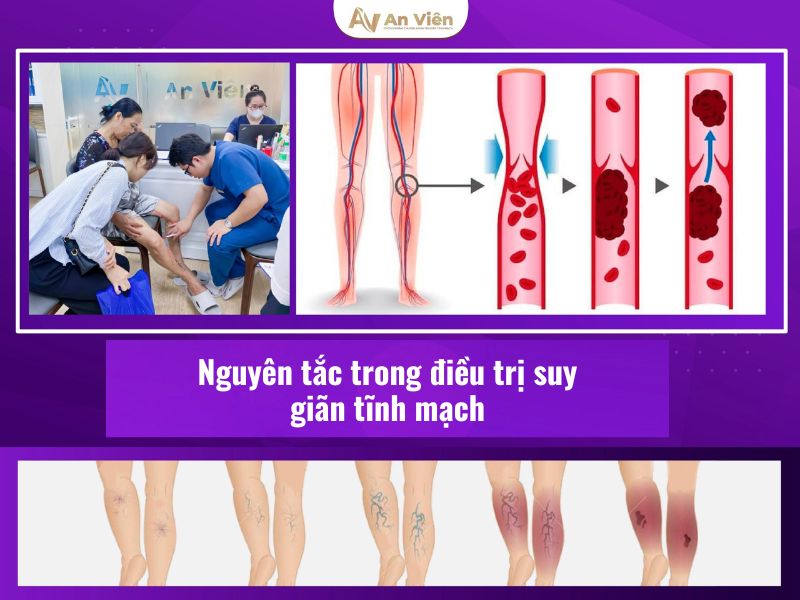 giãn tĩnh mạch chân và cách điều trị