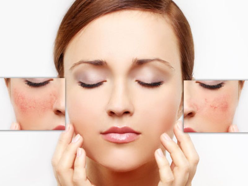 mạch máu nổi rõ trên da mặt