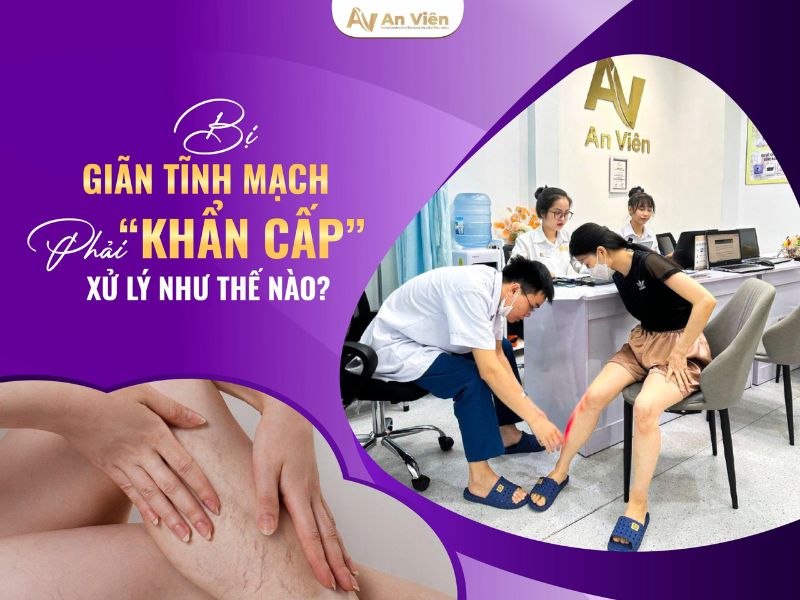 tác hại của bệnh suy giãn tĩnh mạch