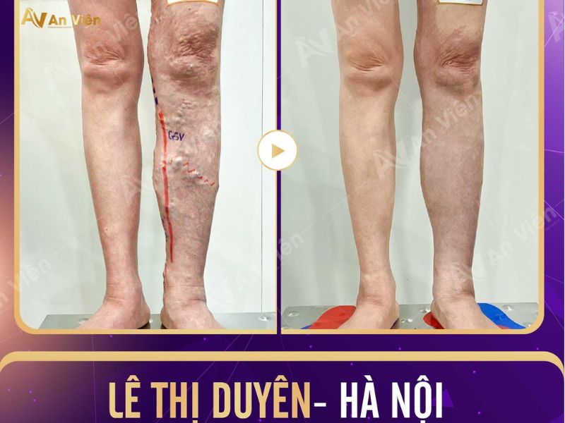 bệnh suy tĩnh mạch có chữa được không