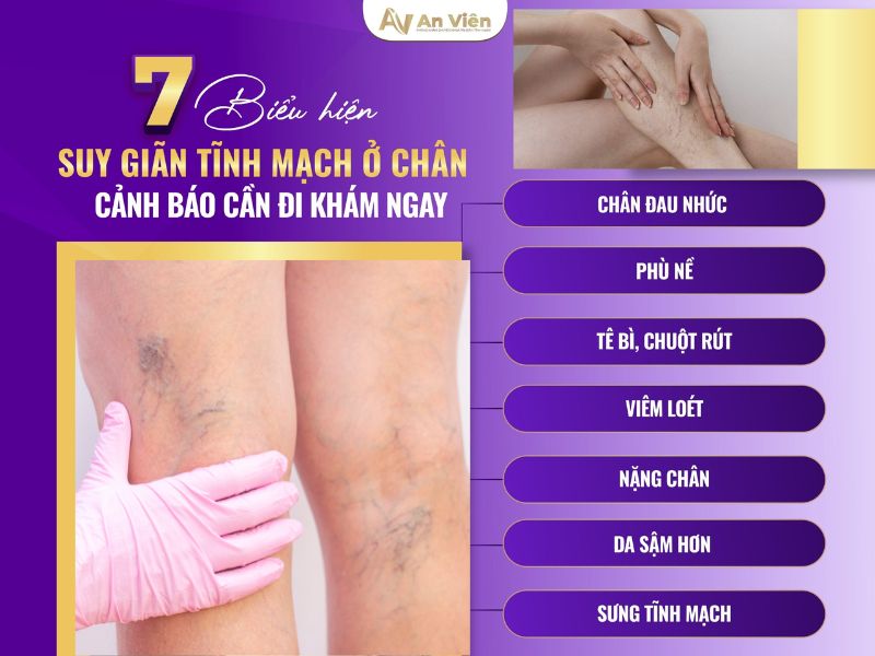 bị giãn tĩnh mạch chân có sao không