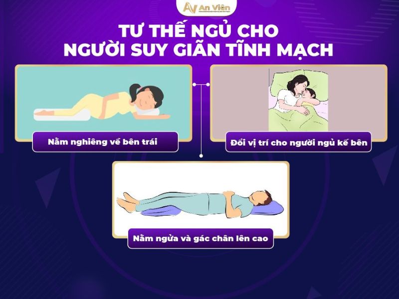 bị giãn tĩnh mạch chân có sao không