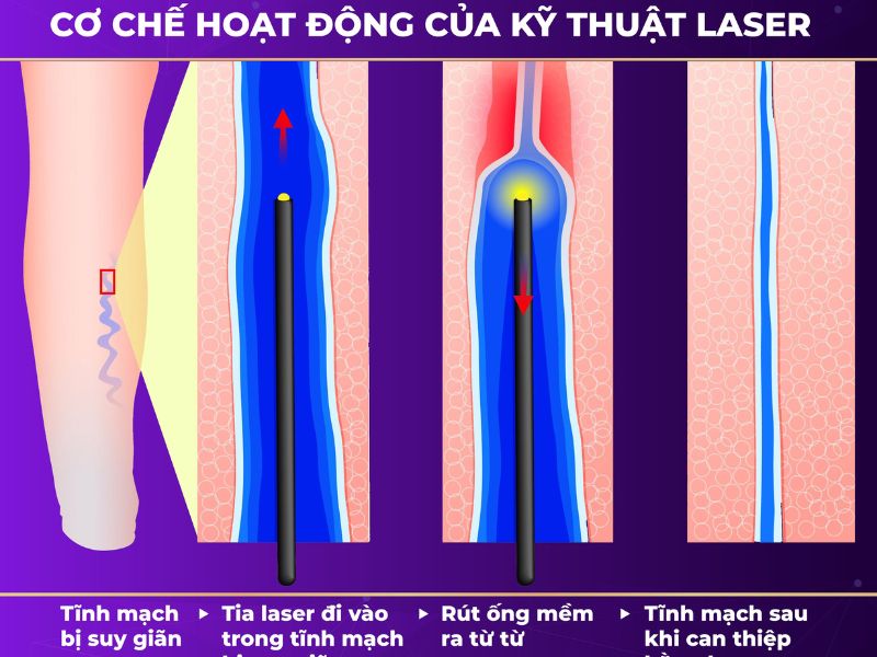 bị giãn tĩnh mạch chân có sao không