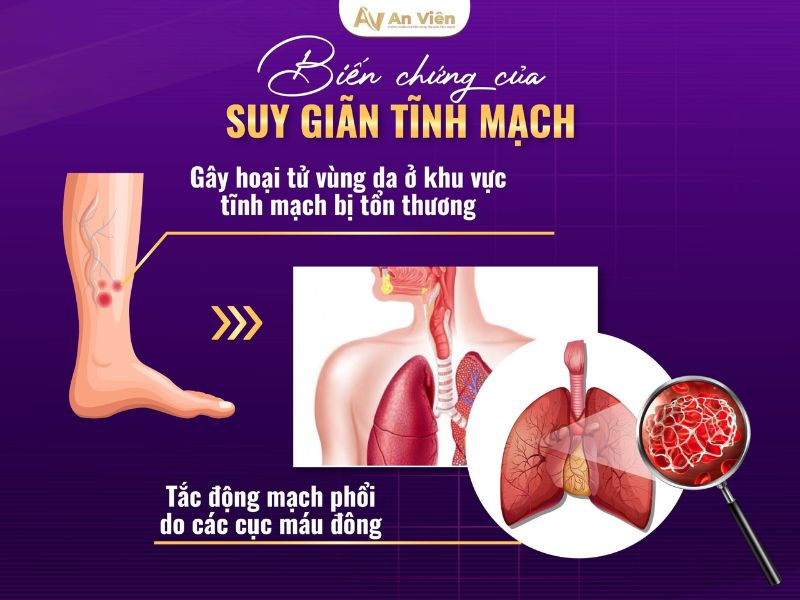 bị giãn tĩnh mạch chân có sao không