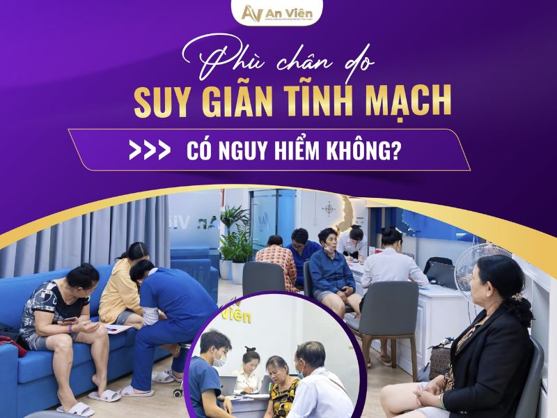 biểu hiện giãn tĩnh mạch ở chân