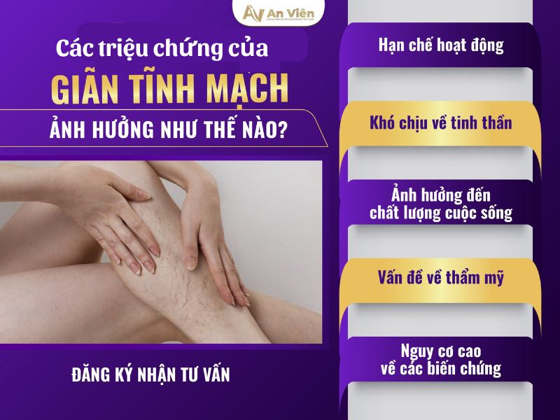 biểu hiện giãn tĩnh mạch ở chân