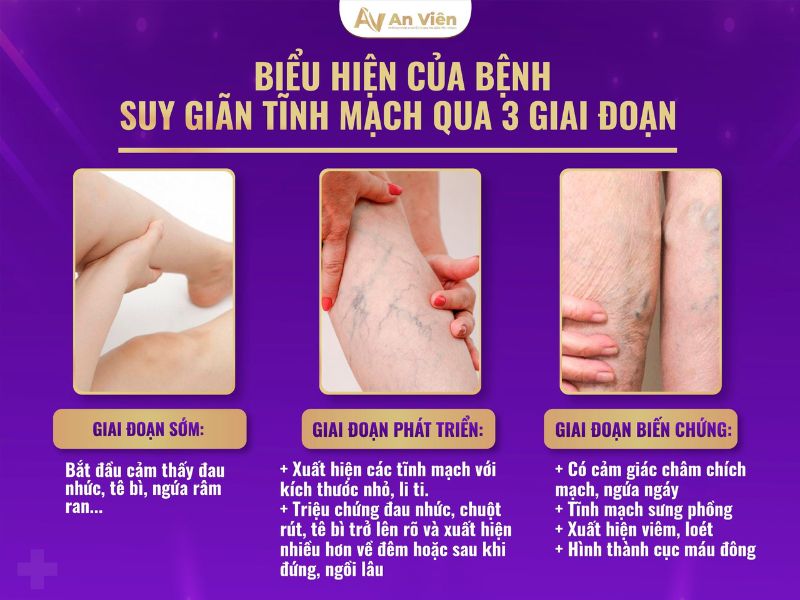 cách trị nổi gân tay chân