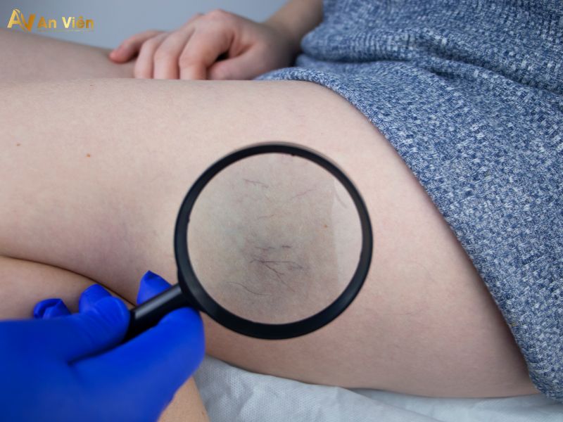 chân bị nổi mạch máu đỏ