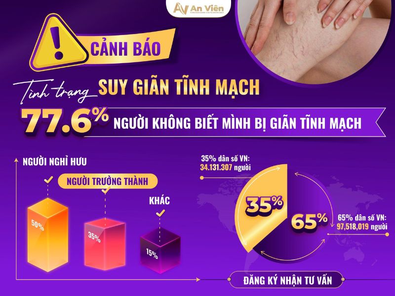 chân bị suy giãn tĩnh mạch