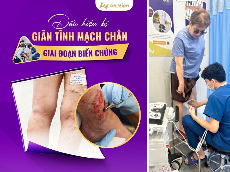 chân bị suy giãn tĩnh mạch
