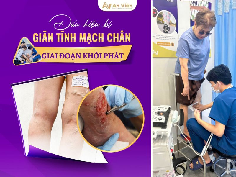 dấu hiệu giãn tĩnh mạch