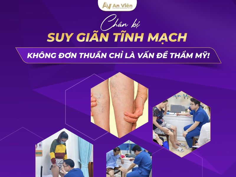 dấu hiệu giãn tĩnh mạch