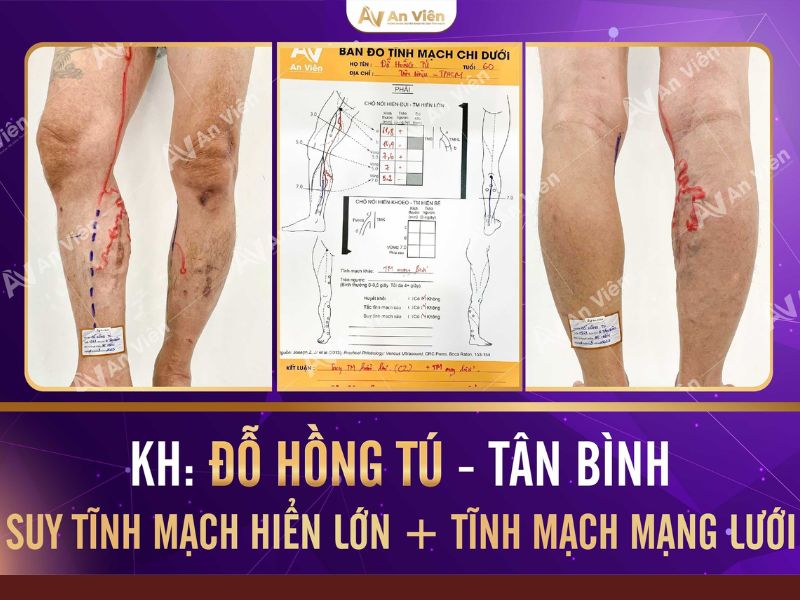 đứng nhiều bị giãn tĩnh mạch chân