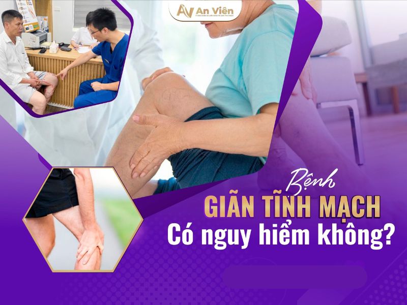 giãn tĩnh mạch chi dưới là gì