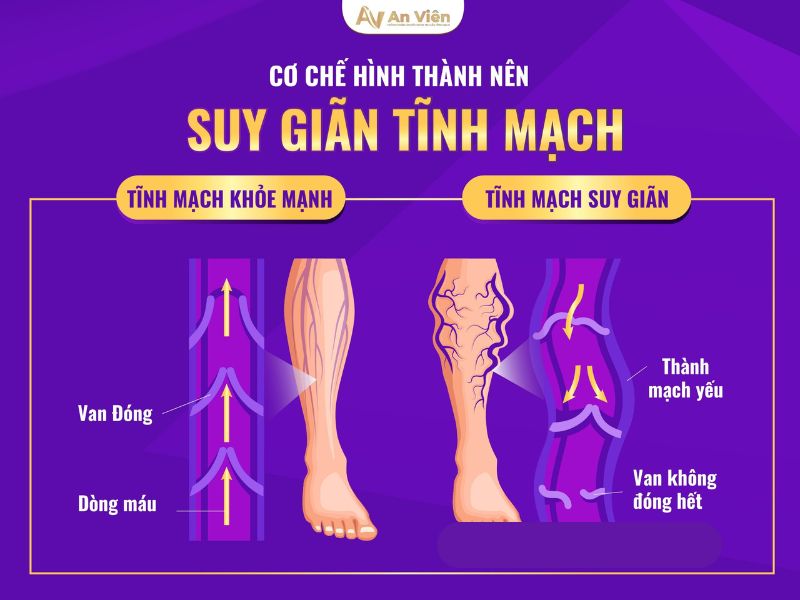 giãn tĩnh mạch chi dưới là gì