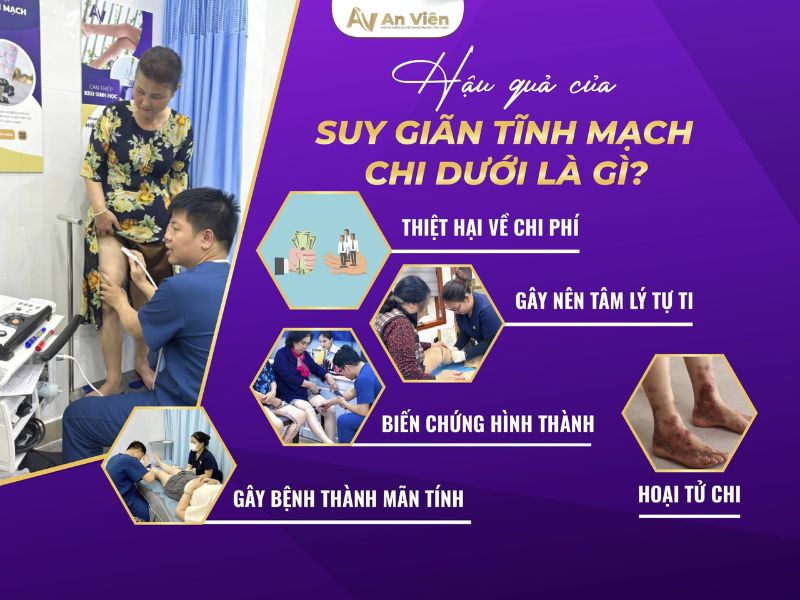 giãn tĩnh mạch chi dưới là gì