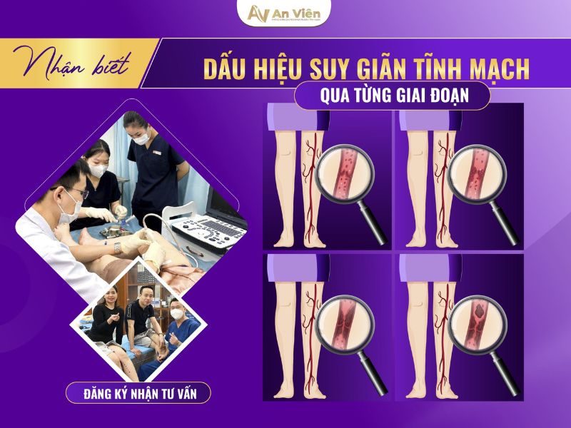 giãn tĩnh mạch có sao không
