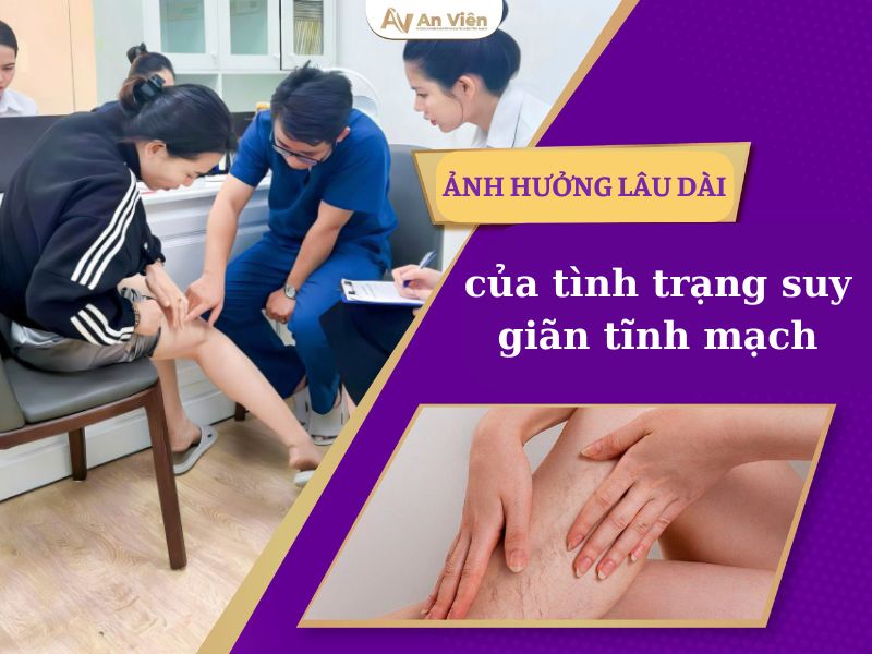 giãn tĩnh mạch có sao không