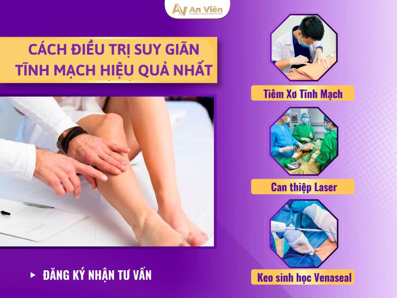 giãn tĩnh mạch có sao không