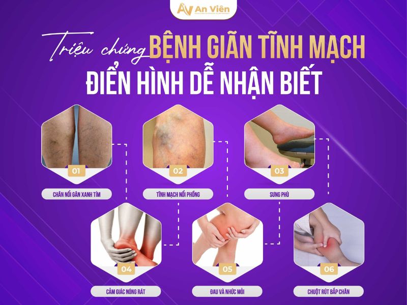 nguyên nhân gây bệnh giãn tĩnh mạch