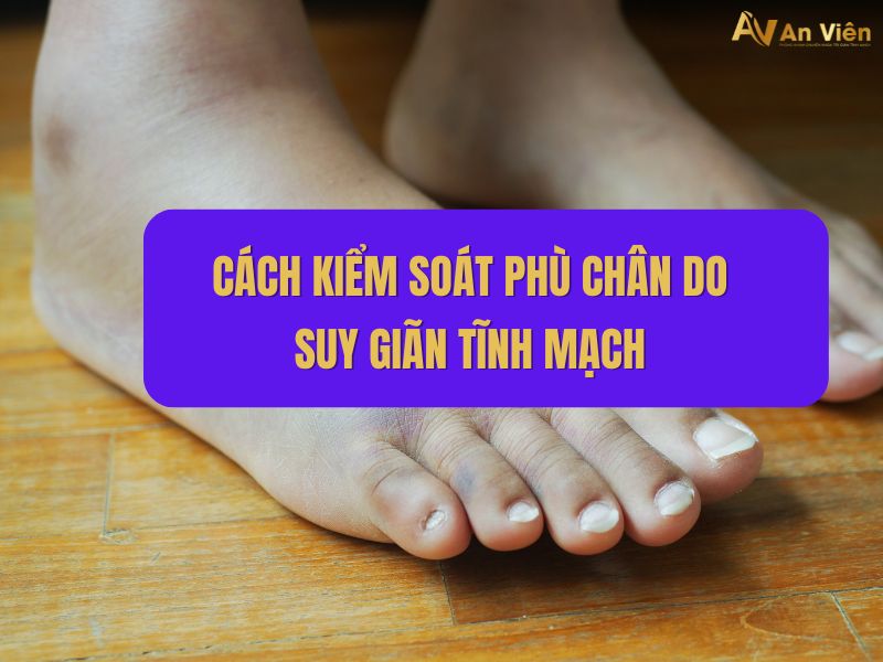 phù chân do suy giãn tĩnh mạch