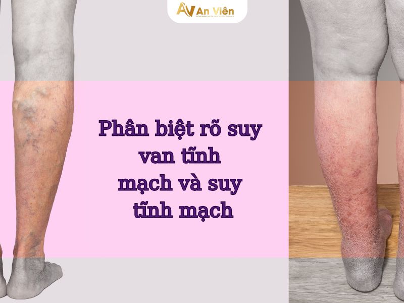 suy tĩnh mạch là gì